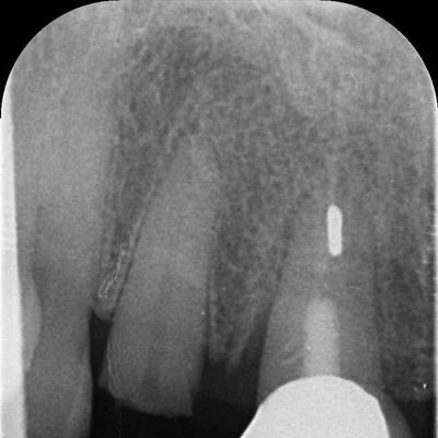 Dental X-Ray Photo